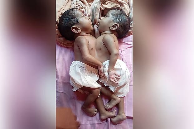 জোড়া লাগা যমজ শিশু দুটি মারা গেছে