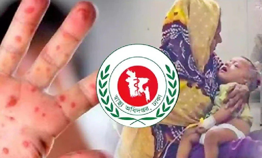 হাম উপসর্গে আরও ৩ জনের মৃত্যু