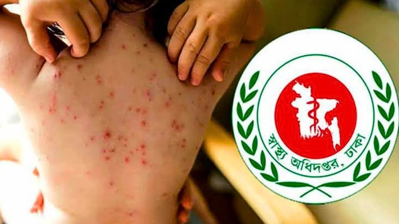 হাম উপসর্গে প্রাণ হারালো আরও ৩ শিশুর
