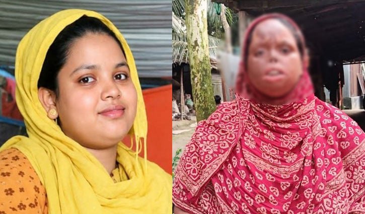 প্রেমের বিয়ের ১০ বছর পর পোড়া মুখে বিচ্ছেদের ক্ষত
