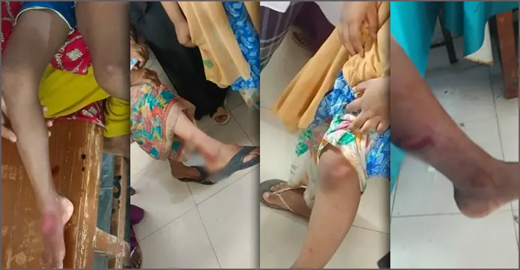পাগলা কুকুরের কামড়ে শিশুসহ আহত ১০