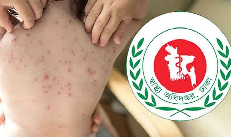 হামের উপসর্গে আরও ৪ মৃত্যু, শনাক্ত ১৭০