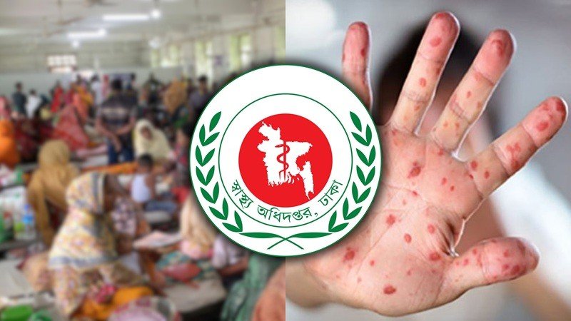 হাম উপসর্গে আরো দুই শিশুর মৃত্যু